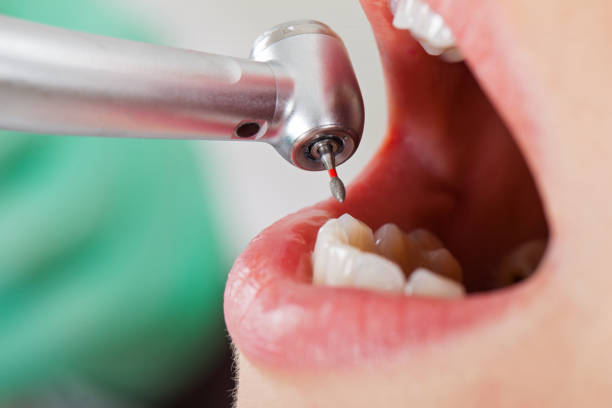 Best Emergency Wisdom Teeth Removal in Steele Creek, AK
